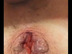 Solo anal prolapse n