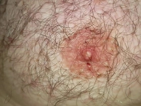 Foley catheter and safety-pins extraction